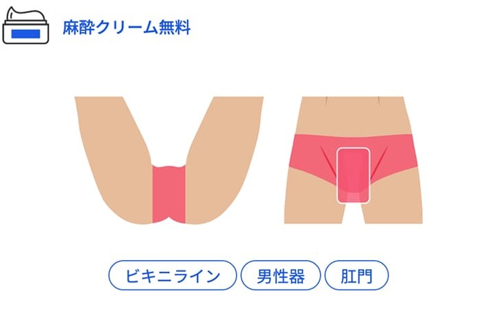 VIO脱毛の図