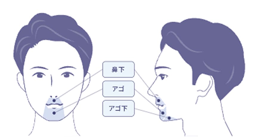 ヒゲ脱門コース対象範囲の図