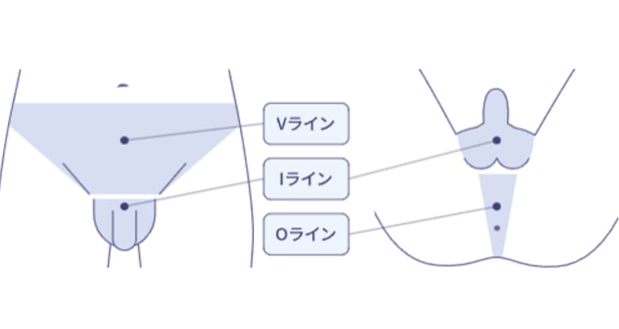 VIO対象範囲の図