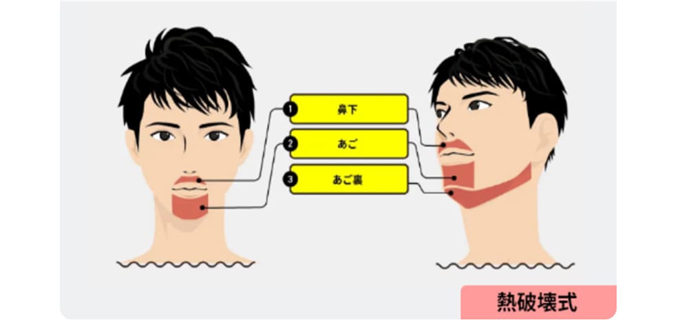 ヒゲ脱毛(3部位)の範囲図
