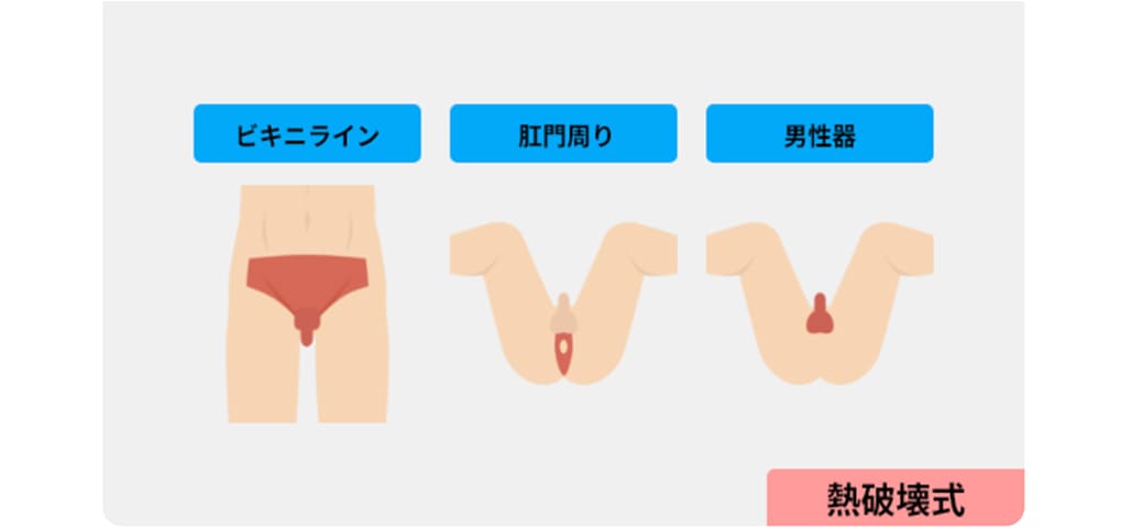 VIO脱毛範囲図