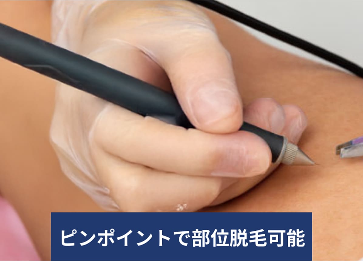 ピンポイントで部位脱毛可能